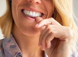 Nose-to-neck view of woman pressing Invisalign over upper arch