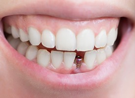 Closeup of a dental implant