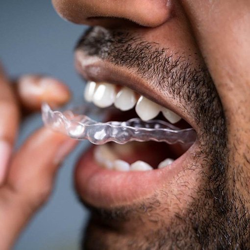 Bearded man putting in a Candid clear aligner in Chevy Chase, MD