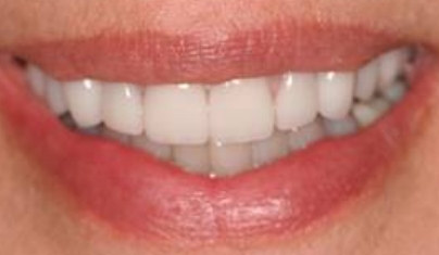 Healthy white smile after teeth whitening