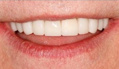 Beautiful healthy smile after cosmetic dentistry