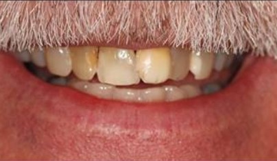 Smile with severe dental discoloration and minor tooth damage