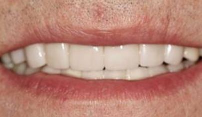 Smile after disxolored tooth is repaired