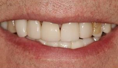 Smile with darkly discolored tooth on the top side