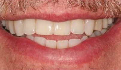 Smile after cosmetic dentistry