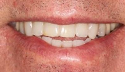 Smile before cosmetic dentistry