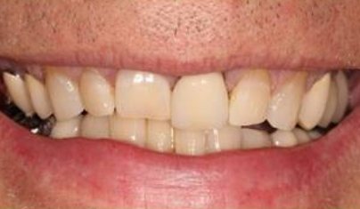 Decayed and discolored teeth before dental treatment