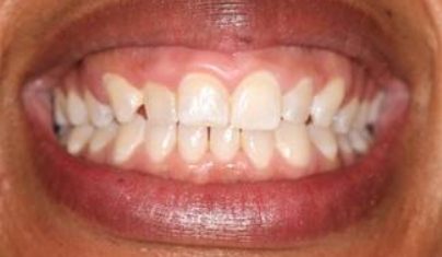 Healthy smile after restorative dentistry