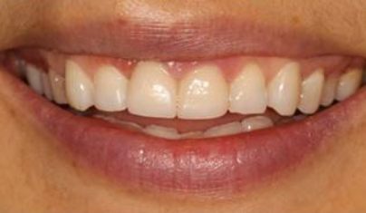 Smile after worn top teeth are repaired