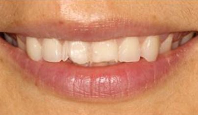 Smile with worn and cracked top teeth