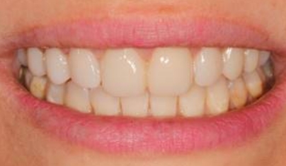 Bright smile after teeth whitening