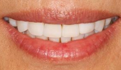 Brilliant smile after teeth whitening