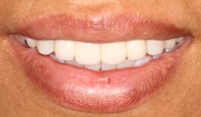 Flawless smile after cosmetic dentistry