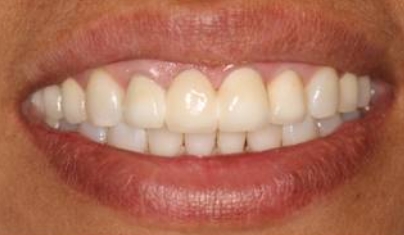 Smile with imperfections before cosmetic dentistry