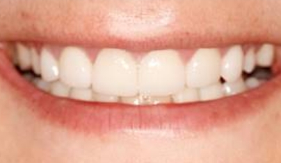 Perfectly aligned evenly spaced teeth after cosmetic dentistry