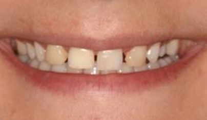 Smile with gaps between teeth before cosmetic dentistry