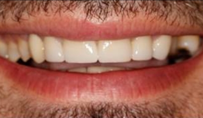 Healthy beautiful smile after cosmetic dentistry