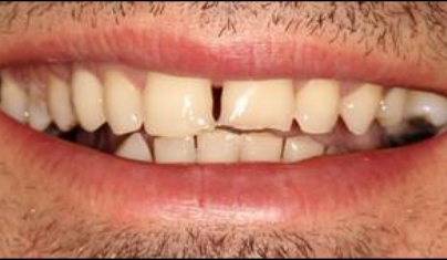 Broken teeth and gap between front teeth before cosmetic dentistry