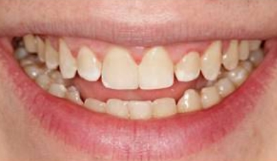 Flawless healthy smile after dental treatment