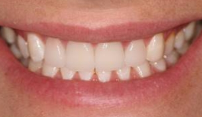 Healthy bright smile after cosmetic dental treatment