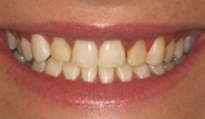 Discolored smile before cosmetic dental treatment
