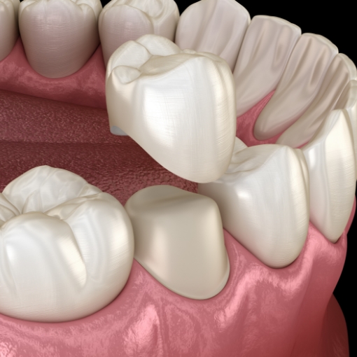 Animated smile during dental crown placement