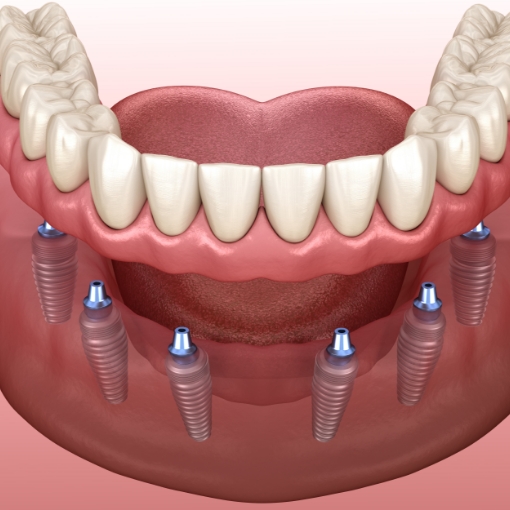Animated smile during full mouth reconstruction with dental implants