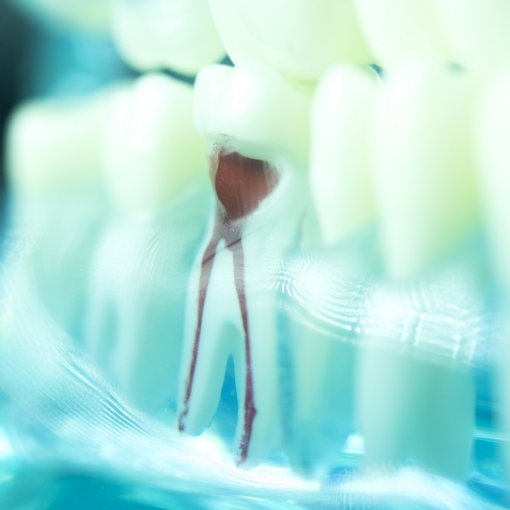 Model tooth after root canal therapy