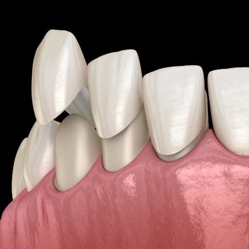 Animated smile during porcelain veneer placement