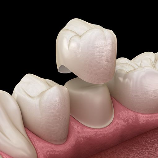 digital illustration of a porcelain dental crown