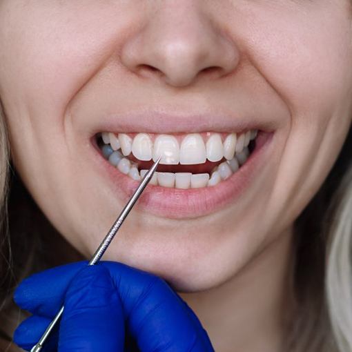 Close up of a smile as the dentist applies Curodont