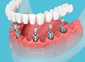 Implant dentures combine the convenience of dentures with the security of dental implants