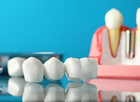 Sample dental bridge and implant on reflective surface with light blue background