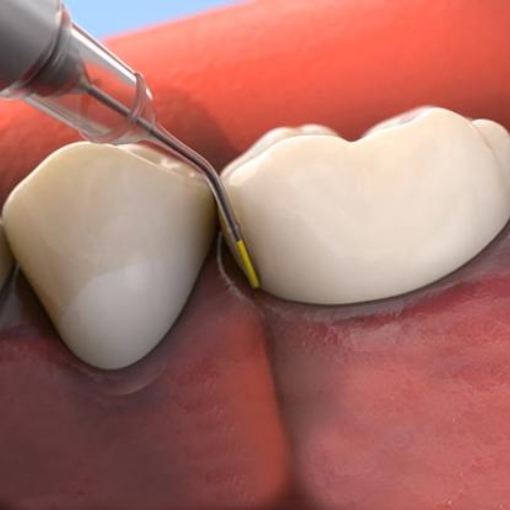 Animated smile during Arestin antibiotic therapy treatment