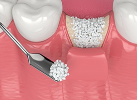 3D render of a bone graft