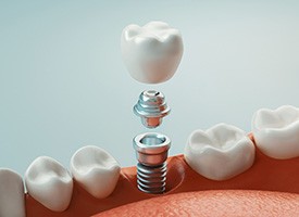 3D render of a dental implant