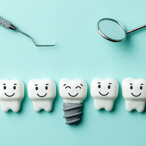 Illustration of dental implant