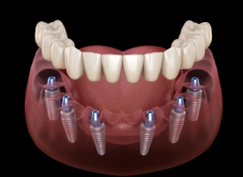 Animated smile during dental implant supported denture placement