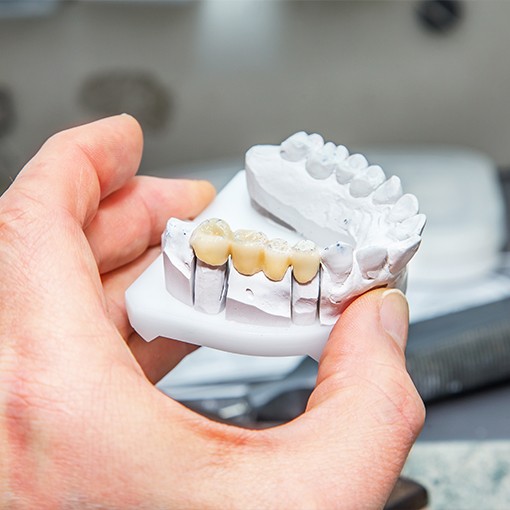 Model smile with dental bridge restoration