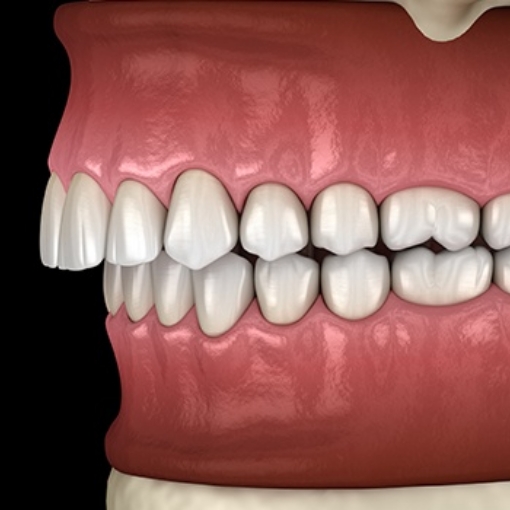 Animated smile in need of equilibration to alleviate T M J pain