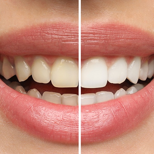 If you have significant tooth stains and healthy teeth, you could be an excellent candidate for professional teeth whitening